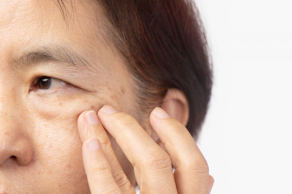 How to Remove Age Spots Naturally: 5 Home Remedies