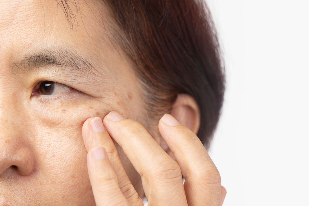 An aging woman with age spots on the face wondering how to remove age spots naturally.