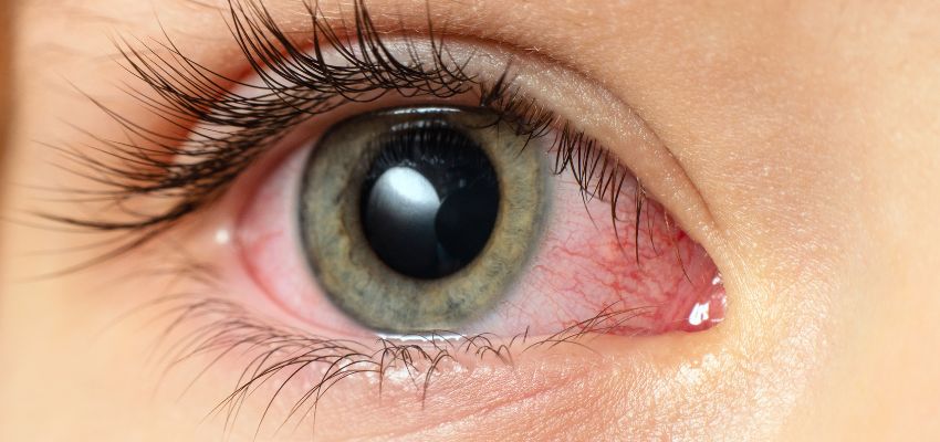 red-eyes-after-lash-extensions1 Close-up of an irritated eye showing redness, a common case of red eyes after lash extensions.